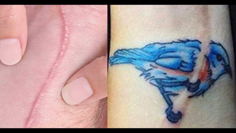 tatuajes para tapar cicatrices de operaciones